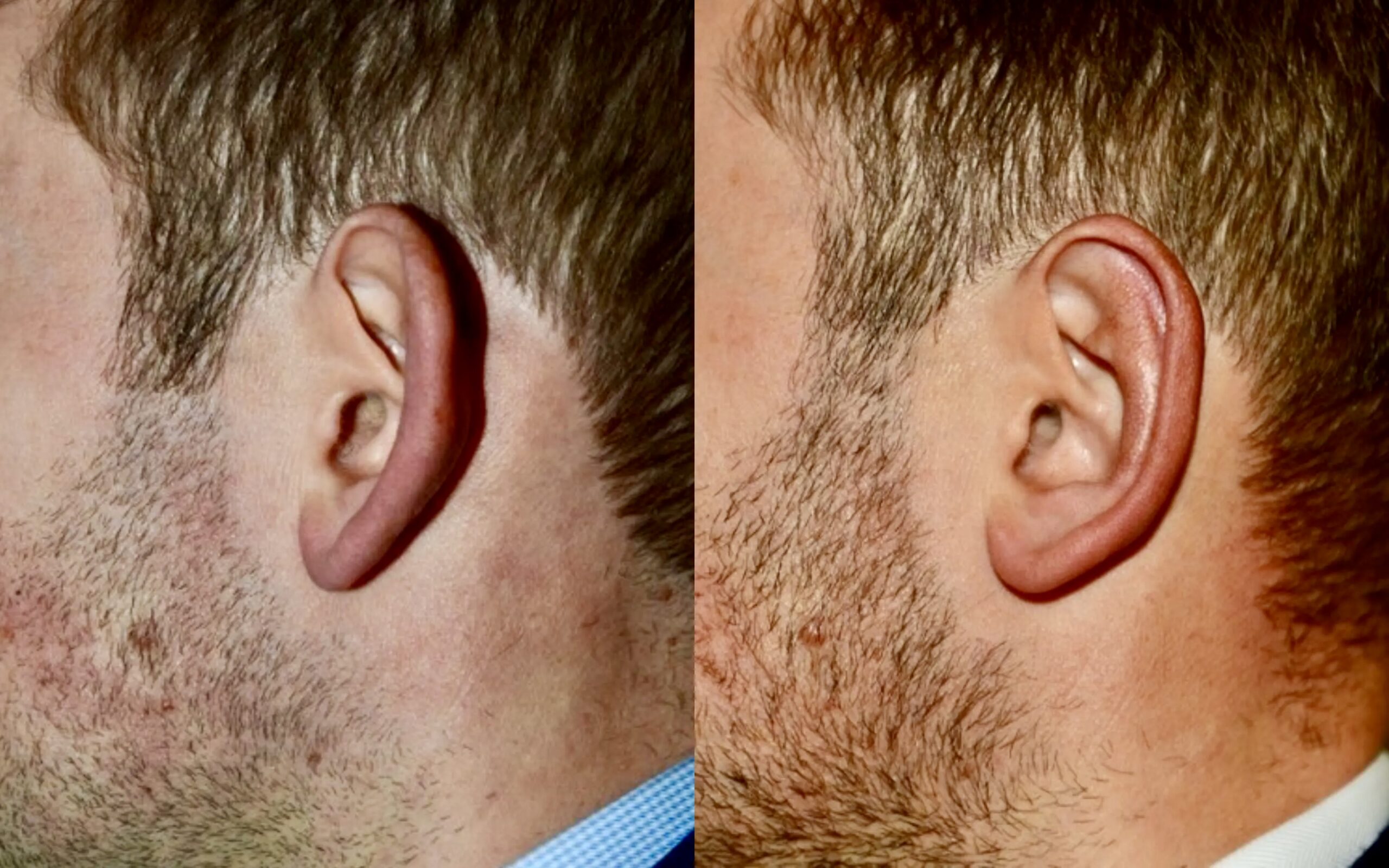 Prominent Ear Correction Edinburgh Otoplasty Waterfront