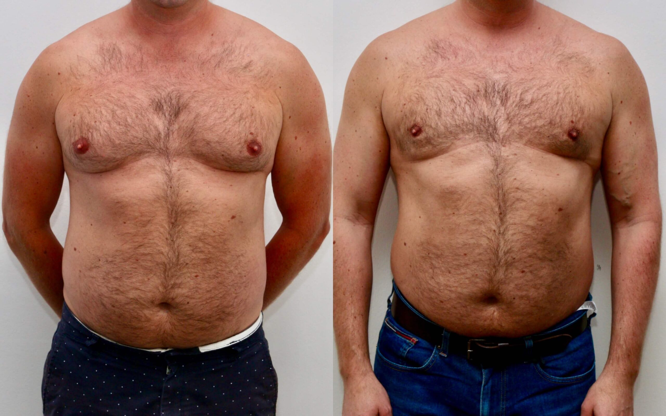 Gynecomastia Surgery Male Breast Reduction Edinburgh 0002