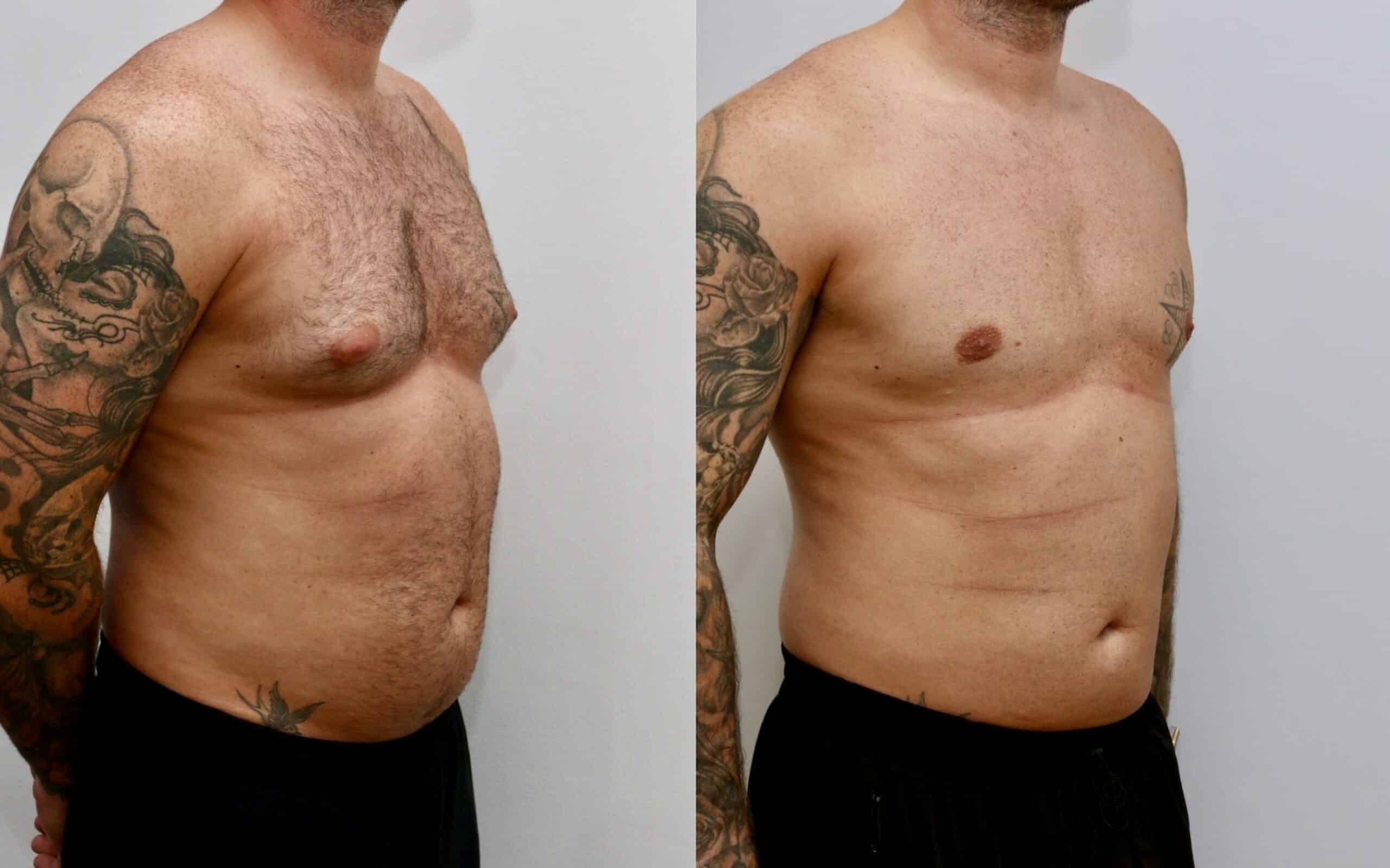 Gynecomastia Surgery Male Breast Reduction Edinburgh