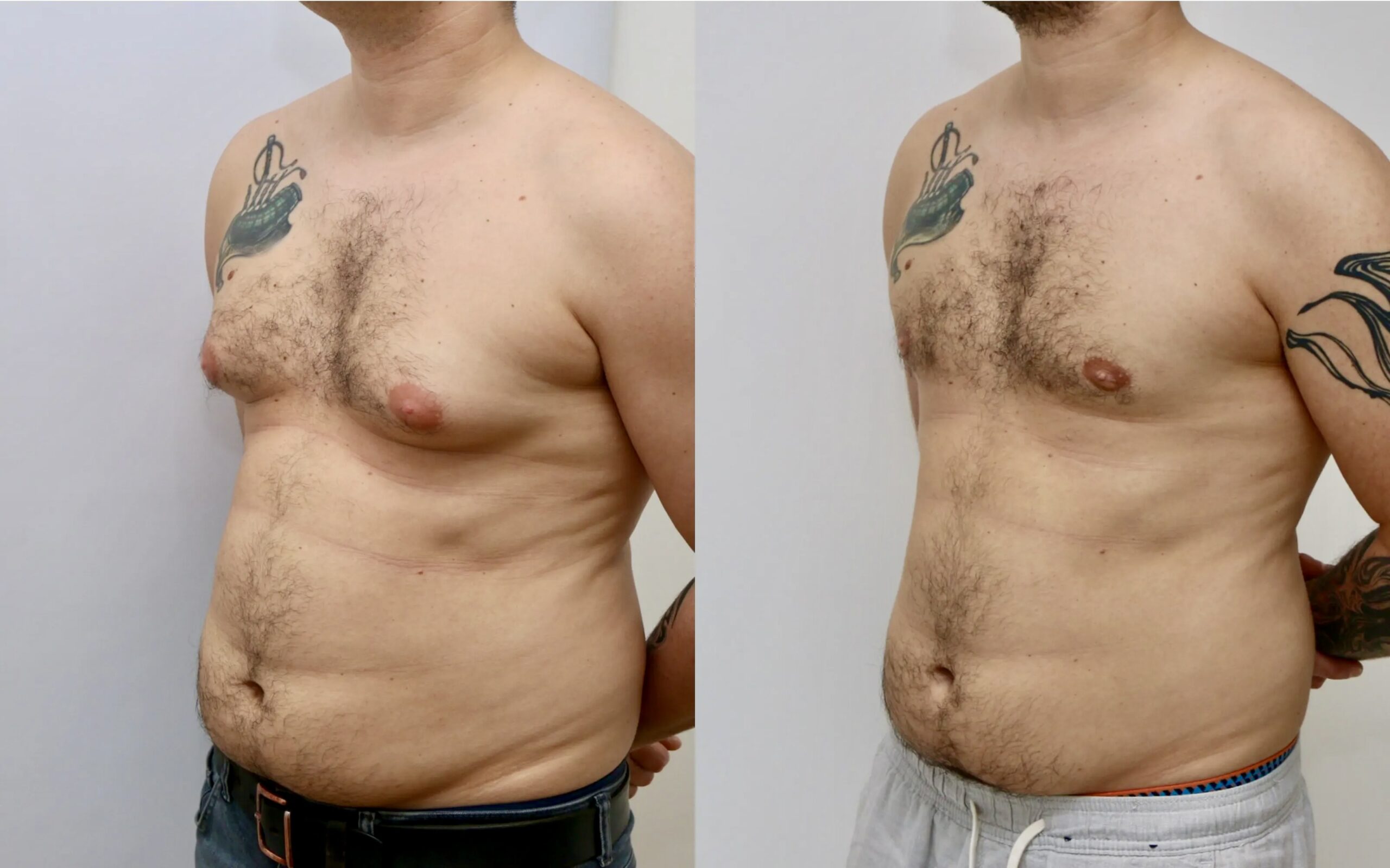 Gynecomastia Surgery Male Breast Reduction Edinburgh