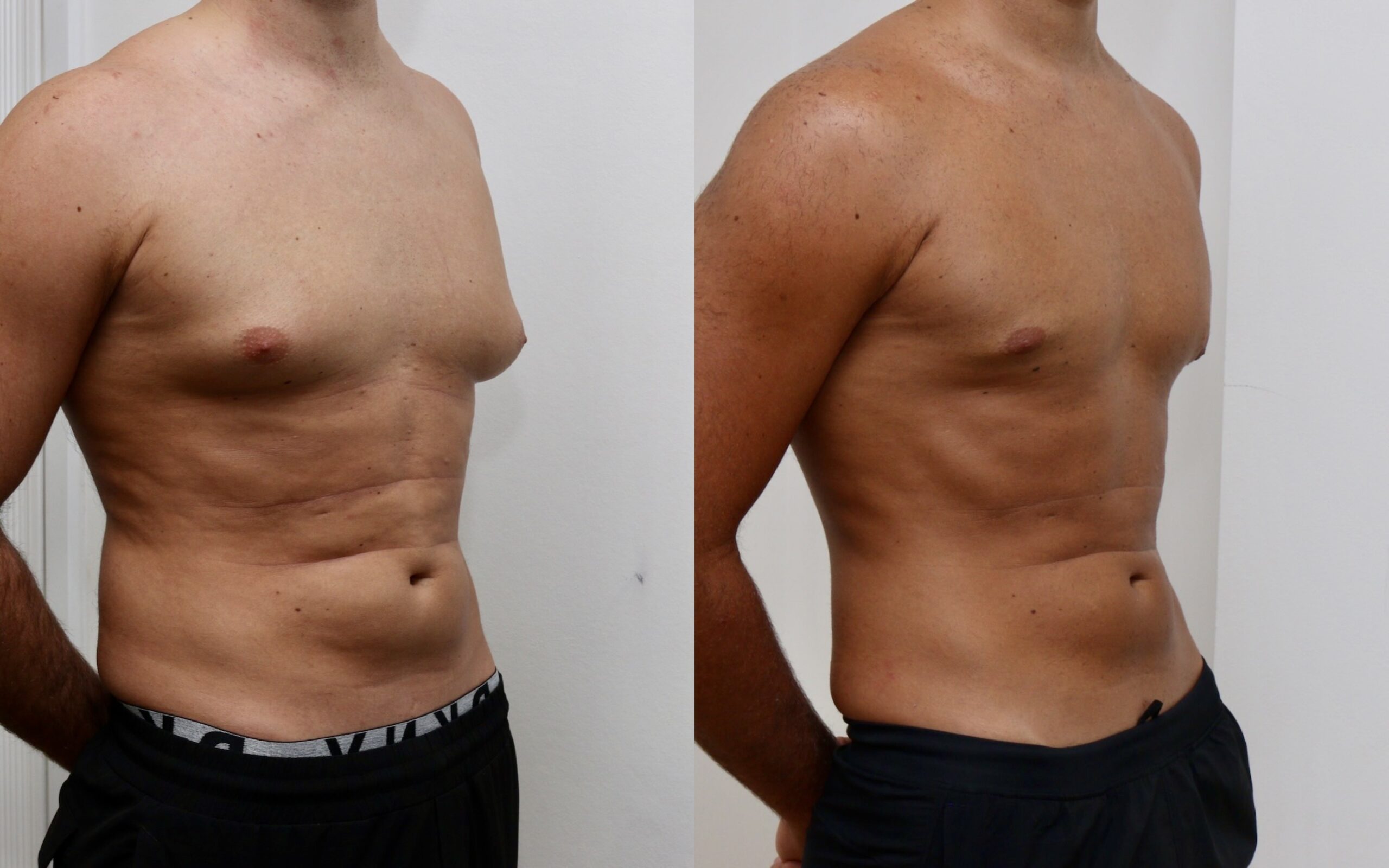 Gynecomastia Surgery Male Breast Reduction Edinburgh