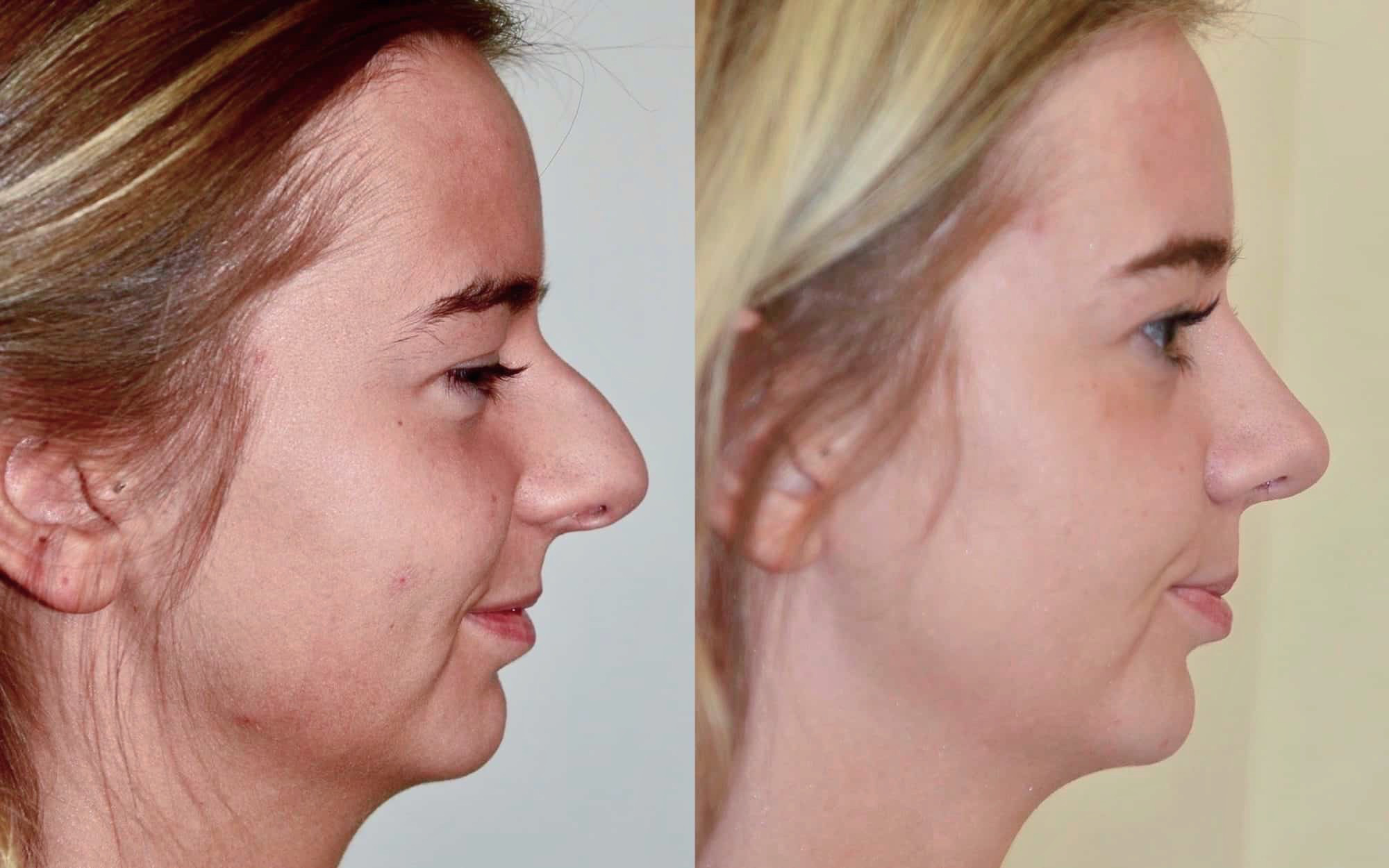 Rhinoplasty Experts in Edinburgh Transform Your Profile No 1