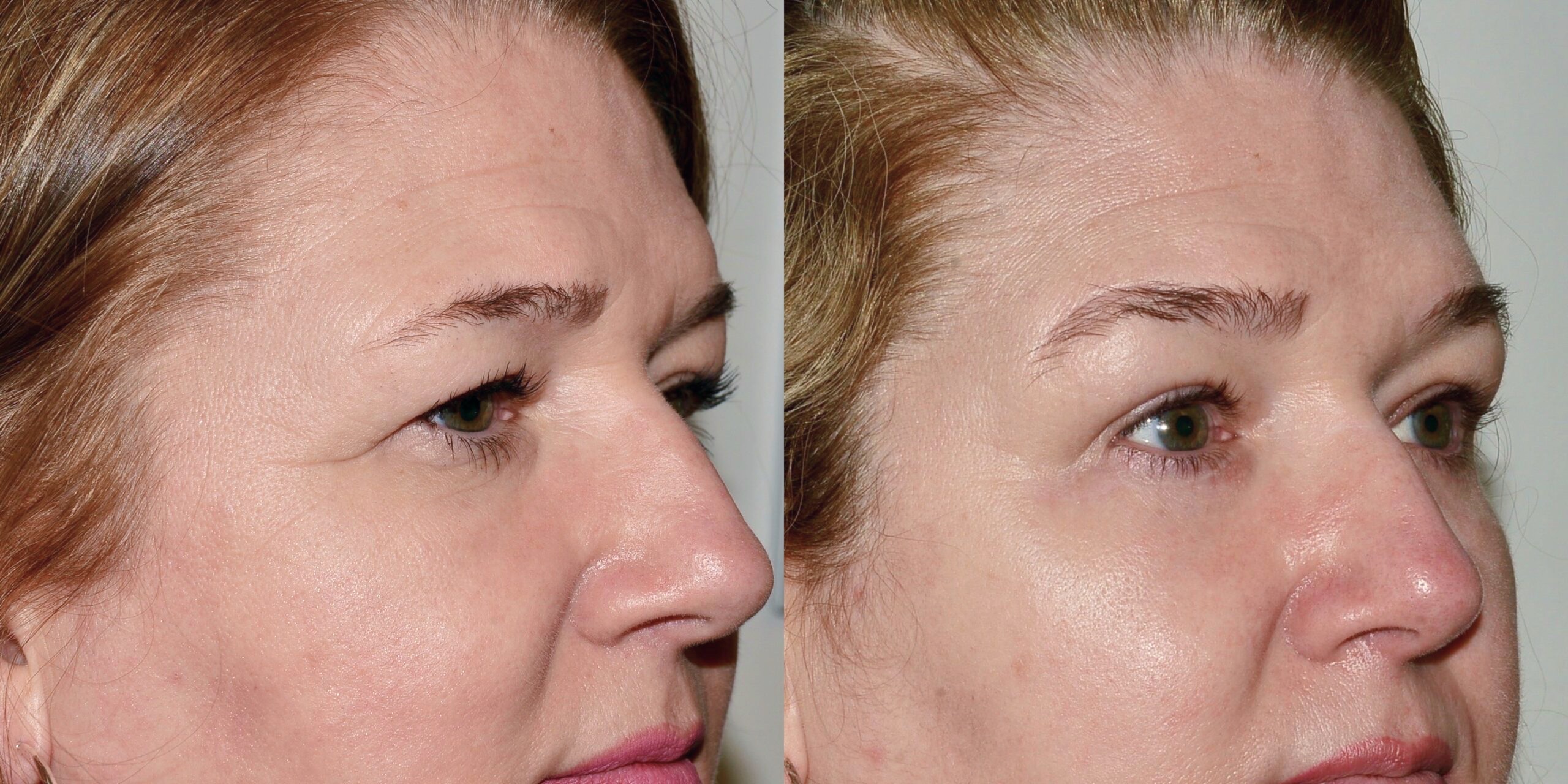 Brow Lift Surgery Edinburgh | Look More Alert